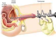 Removal of prostates